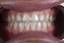 Mouth Changes That Could Mean Your Gums Need Professional Help